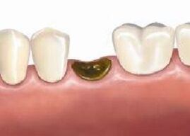 Complicazioni dopo l'estrazione dei denti